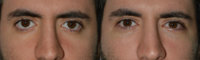 How-to-Get-Attractive-Eyelids-1-1.jpg