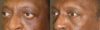 More-Attractive-Eyes-in-LA-1.jpg