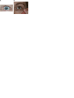 Palpebral-fissure-length-PFL-Distance-between-the-endocanthion-and-exocanthion.png