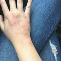 bed-bug-bite-hands.jpg