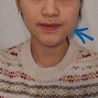 Facial asymmetry due to more fat on one side will buccal v0 5h22nsc5btbe1 Facial asymmetry due to more fat on one side will buccal v0 5h22nsc5btbe1