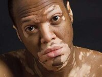Vitiligo dharmesh 22 728 Vitiligo dharmesh 22 728
