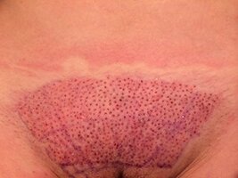 pubic-hair-restoration-surgery.jpg