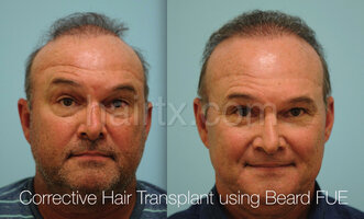 Body-Hair-Transplant-bxa-4.jpg