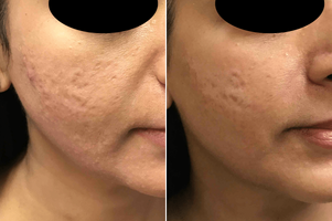 Rf microneedling prp acne scars 57249 46yo indian female rightcheek obliqueview after 4treatme