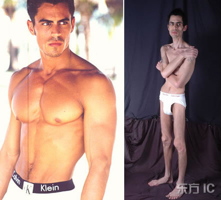 [Image: anorexia_tambem_afeta_o_universo_masculino.jpg]