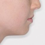 Teeth Overbites | When to See an Orthodontist | Smiles and Faces  Orthodontics