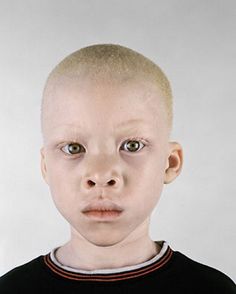 f4ee9733446a12107330fb0673e4b3ab--albino-african-albinism.jpg