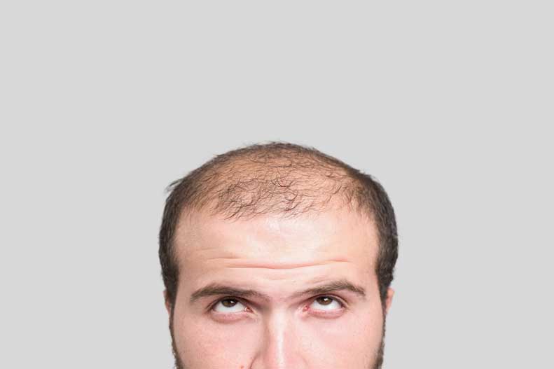 Balding-1.jpg