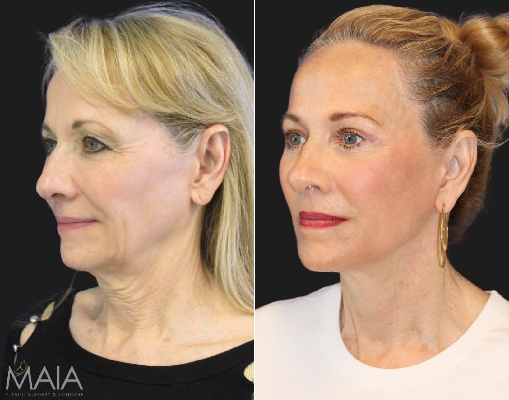 APPROVED-ANGLE-67-year-old-before-and-1-year-after-comprehensive-facial-rejuvenation.jpg