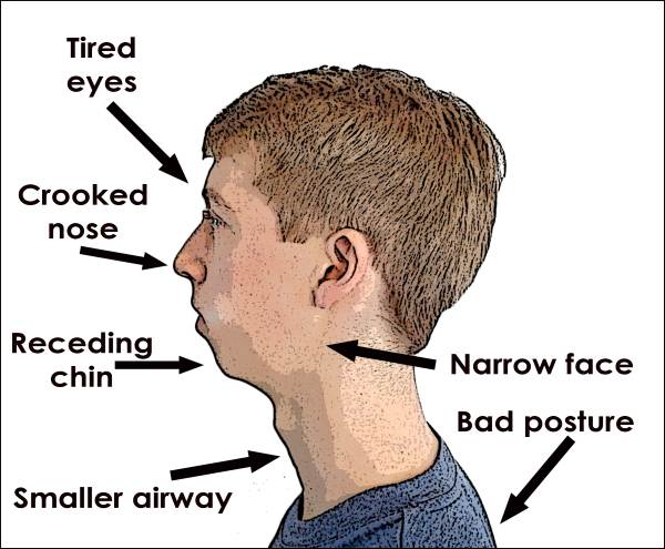 Mouth Breathing and Blocked Nose | ENT Specialist Singapore