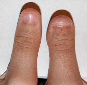 300px-Clubbed_thumb.jpg