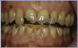 m3_dental_errosions1-1.jpg