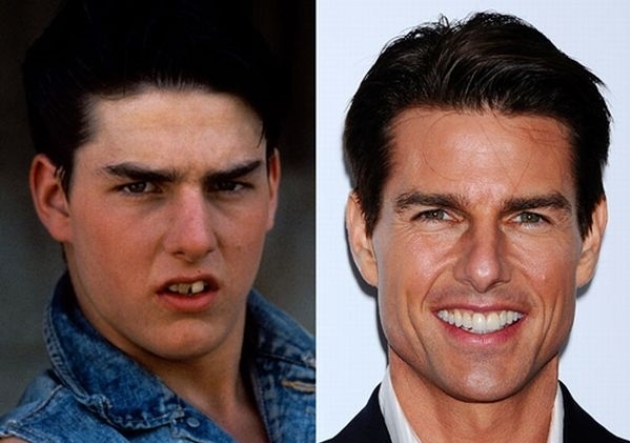 Tom-Cruise-teeth-and-Smile-Before-and-After-Braces.jpg