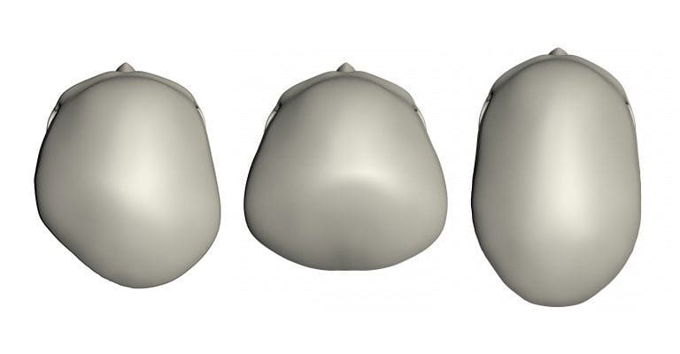 plagiocephaly-examples.jpg