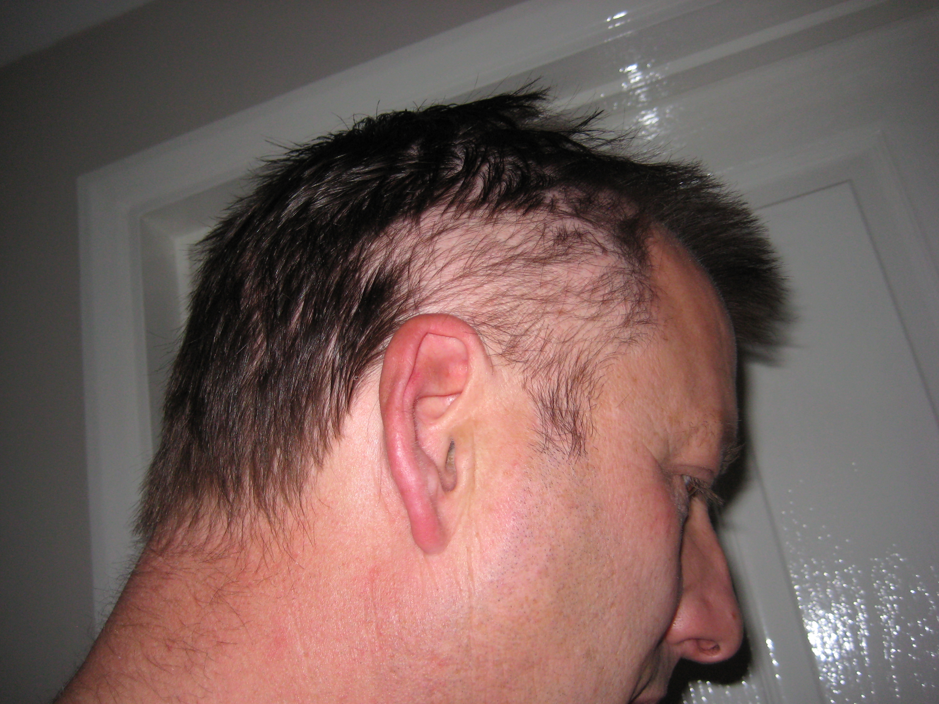 hair-loss-sat-29th-may-2010-side-2.jpg