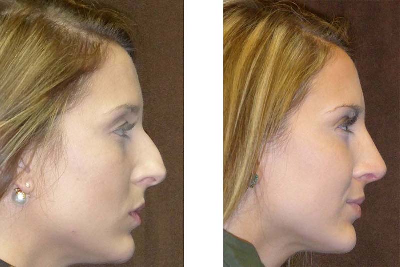 rhinoplasty-bxa.jpg