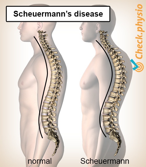 back-scheuermanns-disease-posture-spine-spinal-column-convex-kyphosis.jpg