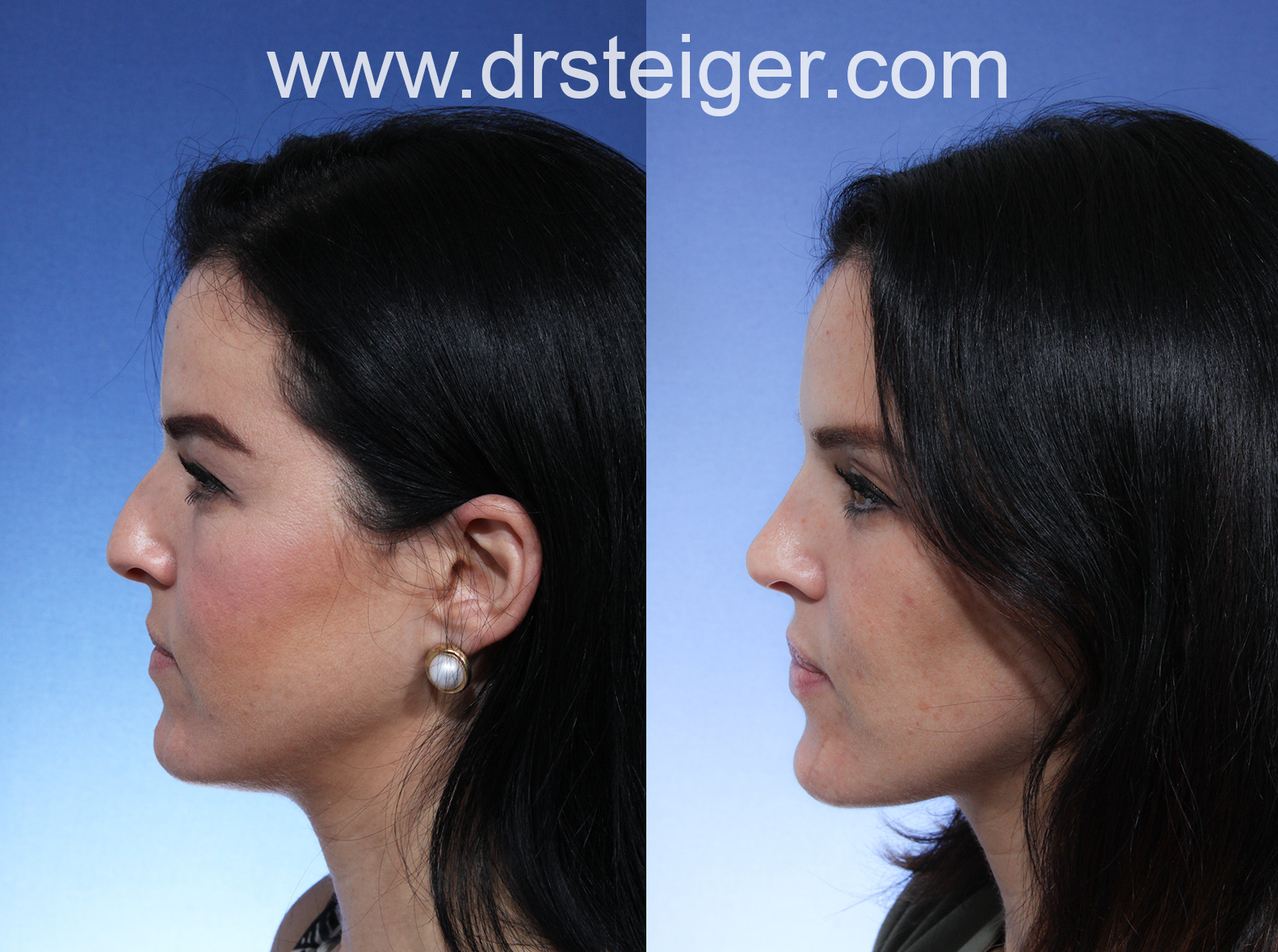 best-rhinoplasty-florida-photo.jpg