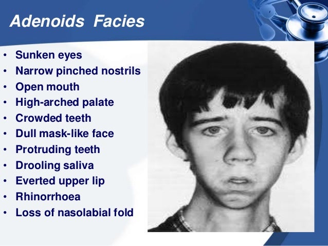 adenoids-10-638.jpg