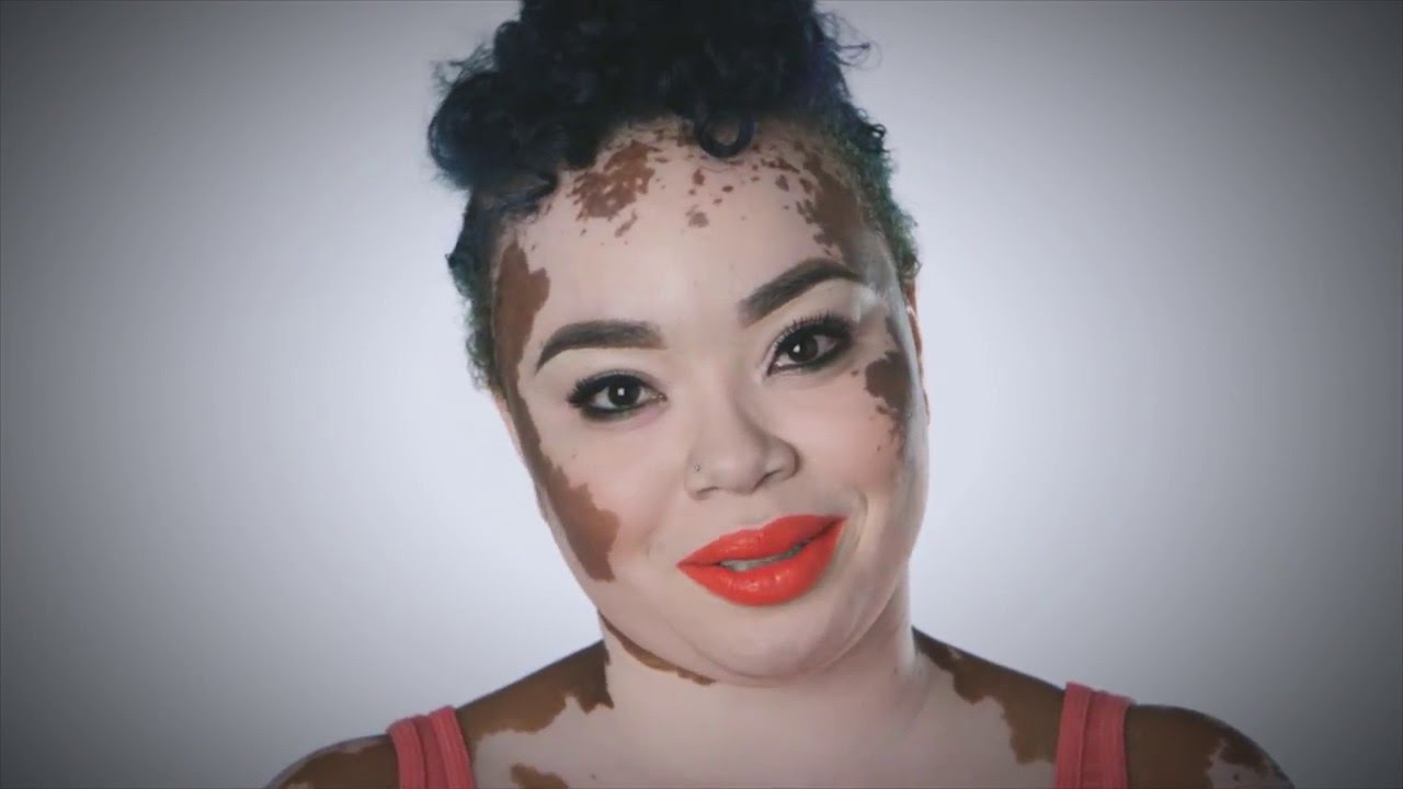 Vitiligo.jpg