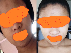 Benoquin Skin Lightening Cream Review - Before and After | SkinAlley |  Discuss Skin Care, Beauty and Hair Issues