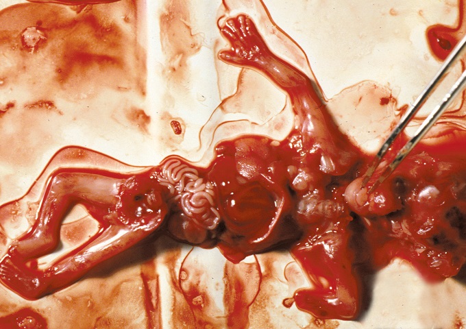 10-week-abortion-01.jpg