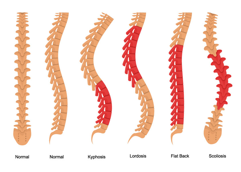 spinal-deformity-types-840x600.jpg