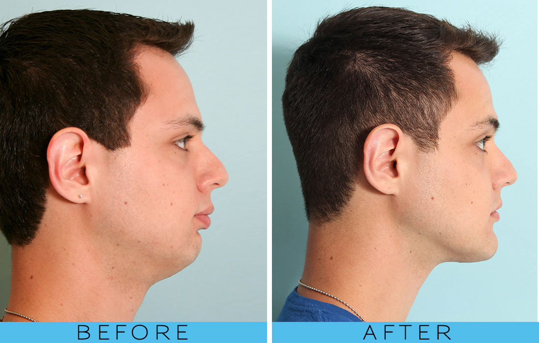 Chin-Implant-Before-and-After-2.jpg