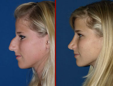 rhinoplasty-before-after.jpg