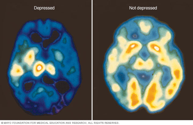 c7-pet-depression-8col.jpg