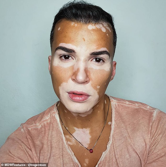Model, 37, with rare skin condition vitiligo says strangers thought  condition was contagious - DUK News