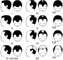 220px-Partial_Norwood_scale_for_male_pattern_baldness.png