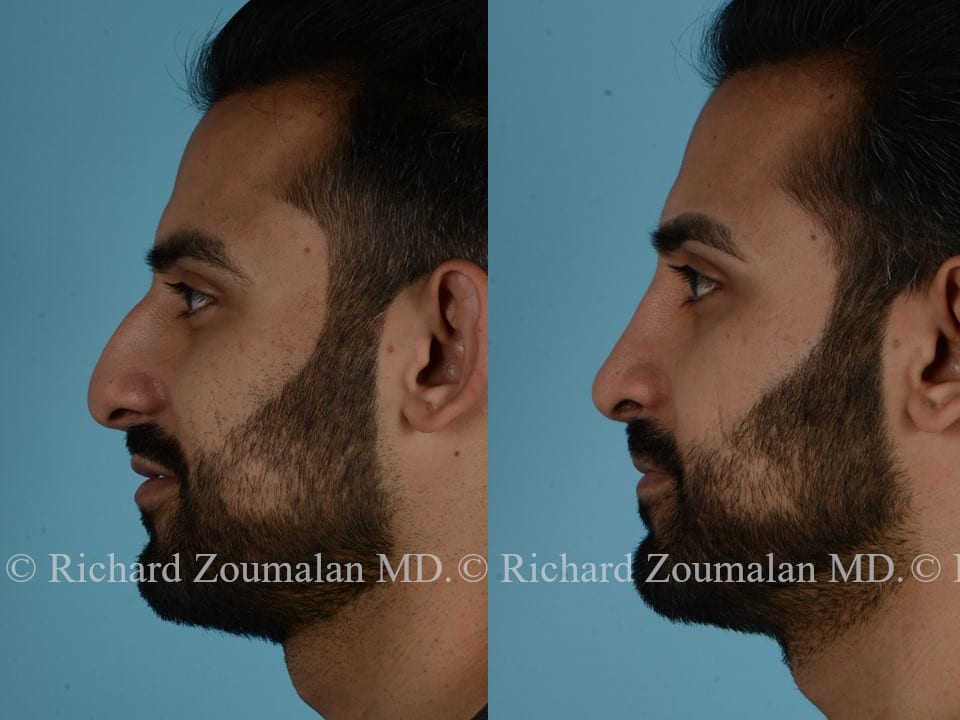 Middle Eastern Rhinoplasty Beverly Hills | Nose Surgery | Dr Zoumalan