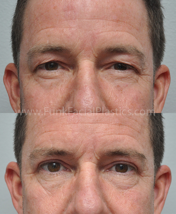 Upper Eyelid Surgery Houston - Eyelid Lift & Upper Blepharoplasty Surgeon |  Funk Facial Plastic Surgery