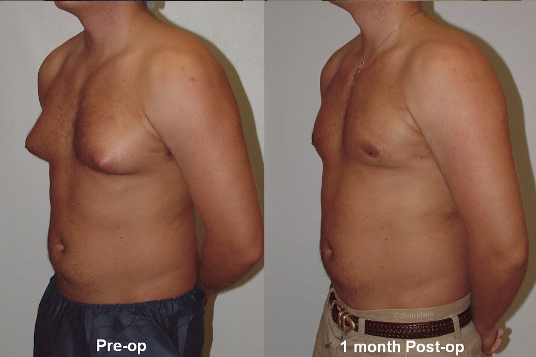 Gynecomastia.jpg