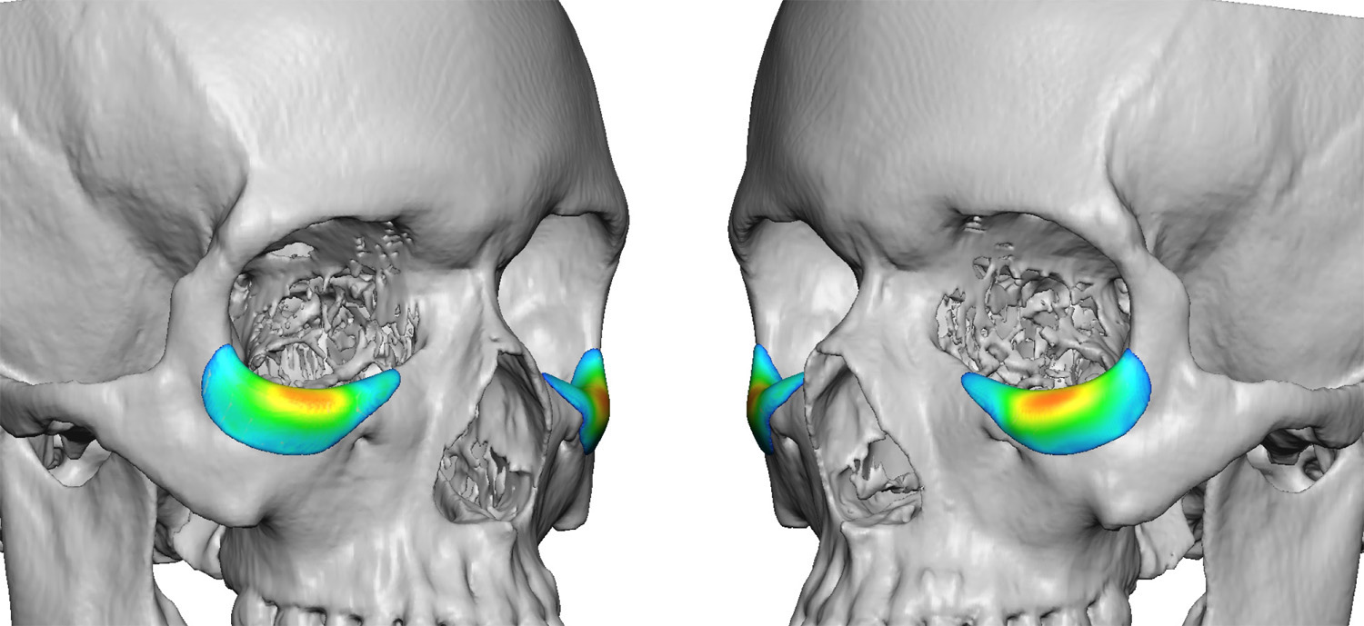 Custom-Infraorbital-Implants-design-Dr-Barry-Eppley-Indianapolis.jpg