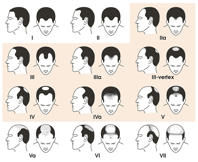 Where-Are-You-on-the-Norwood-Hair-Loss-Scale.jpg