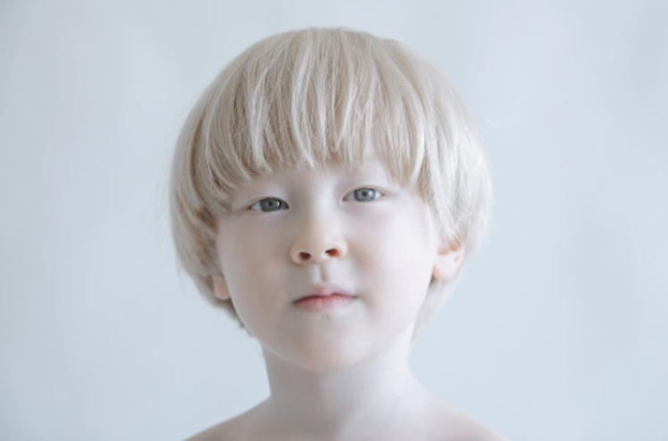 albino-people-9-.png