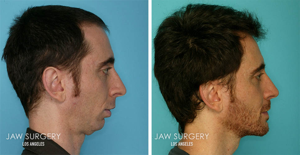 Before & After Photos | Los Angeles, CA | Jaw Surgery LA