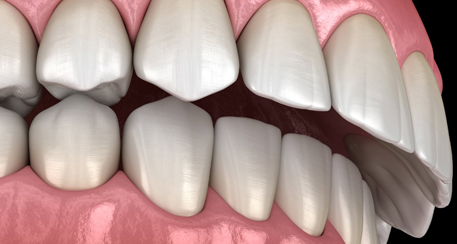 Overbite Treatment - Zara Dental Clinic - Houston 7137661122
