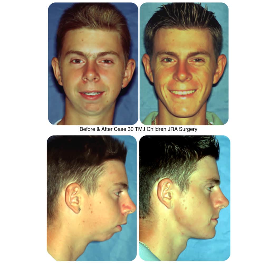 boy-30-tmj-JRA-surgery.jpg