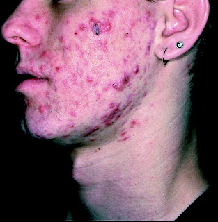 severe+acne+2.jpg
