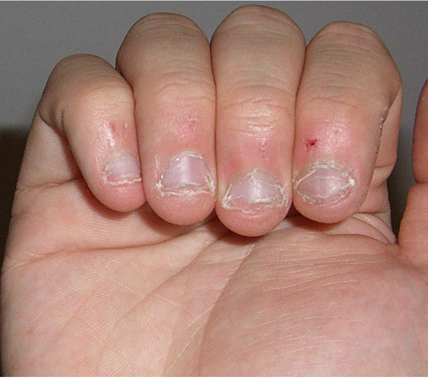 Nailbitebad.jpg