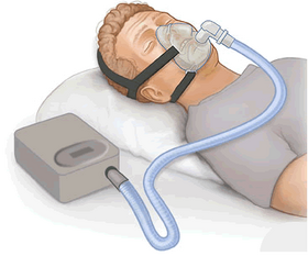 280px-CPAP.png