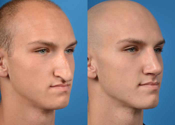 cost-of-rhinoplasty-in-india.jpg