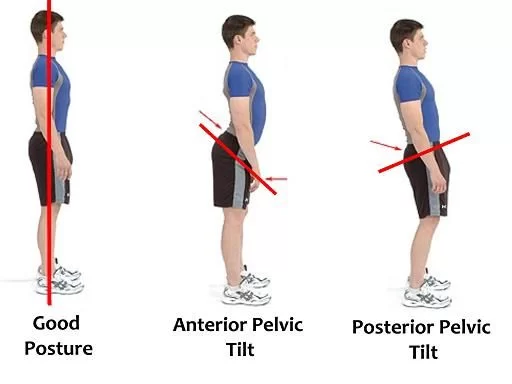 Posterior-pelvic-tilt.webp