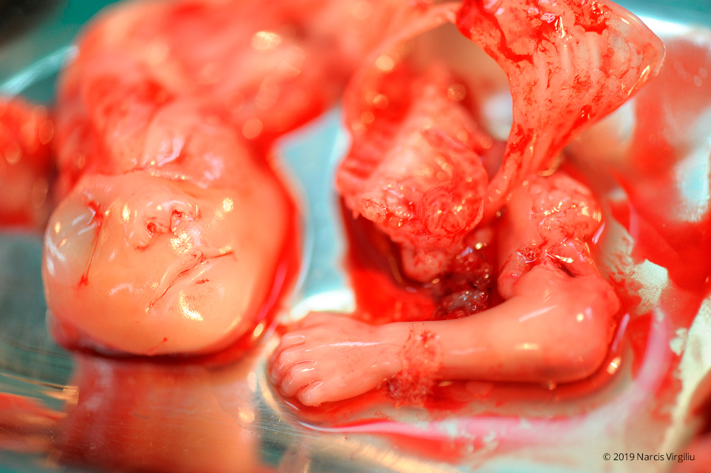 15-week-abortion-03a.jpg