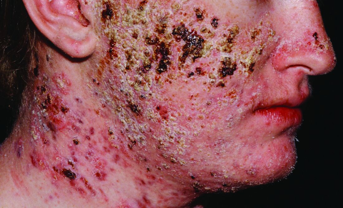 Guidelines on classification, diagnosis, and treatment of acne fulminans |  MDedge Dermatology