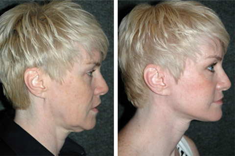 face-lift-before-and-after-photos-01a.jpg